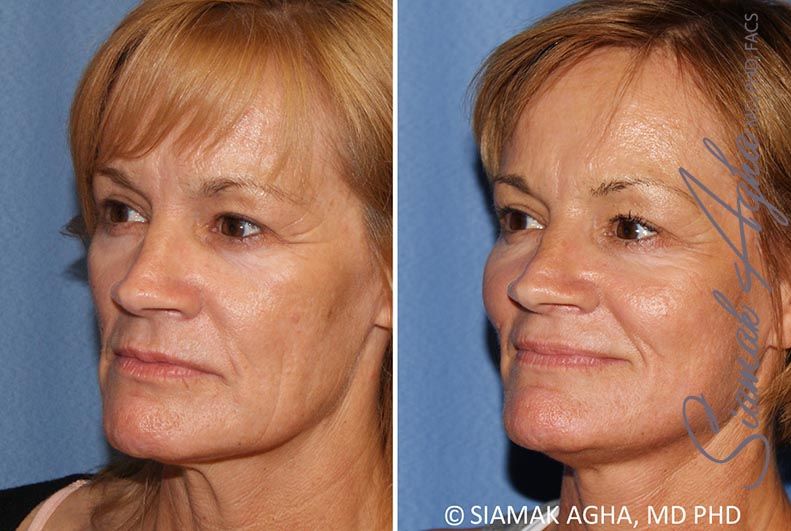 Facelift Before & After