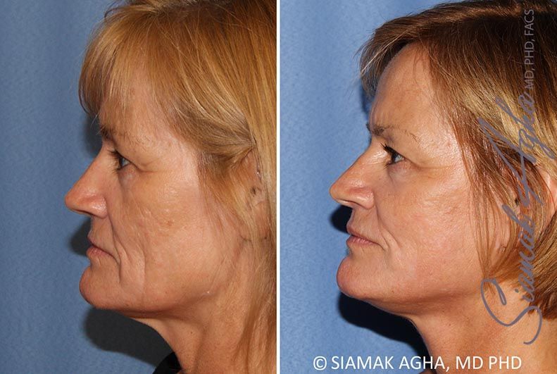 Facelift Before & After