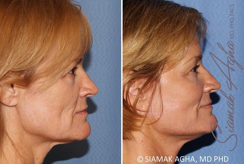 Facelift Before & After