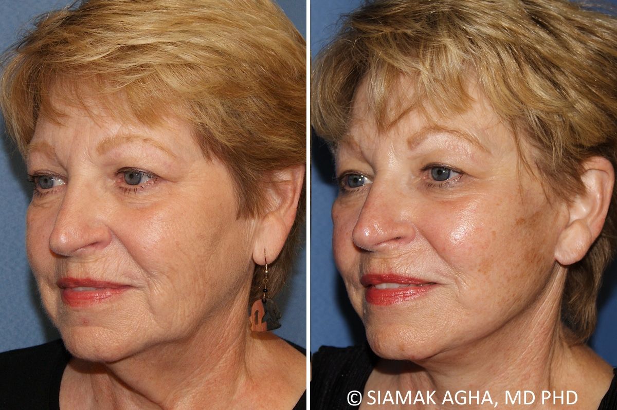 Facelift Before & After