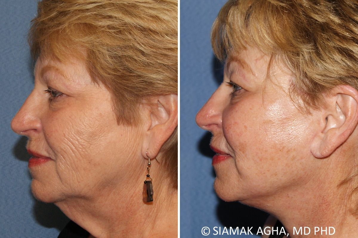 Facelift Before & After