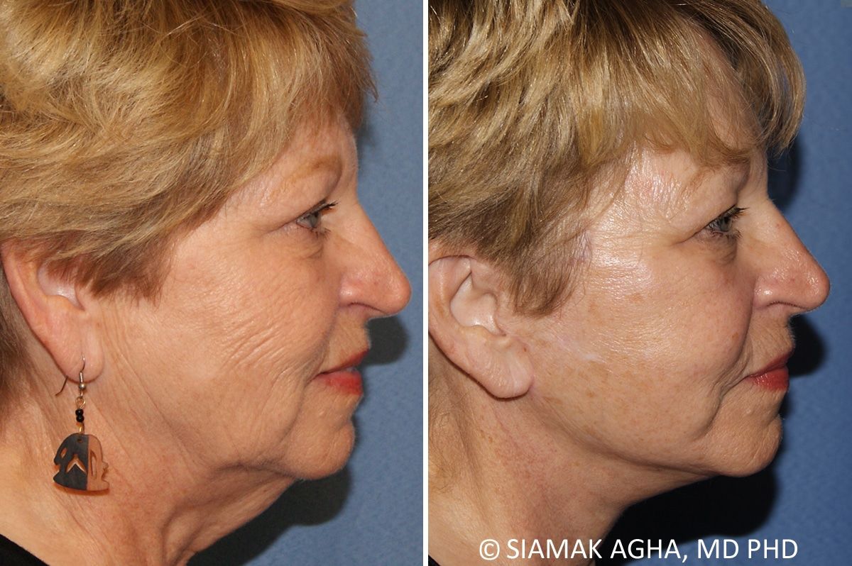 Facelift Before & After