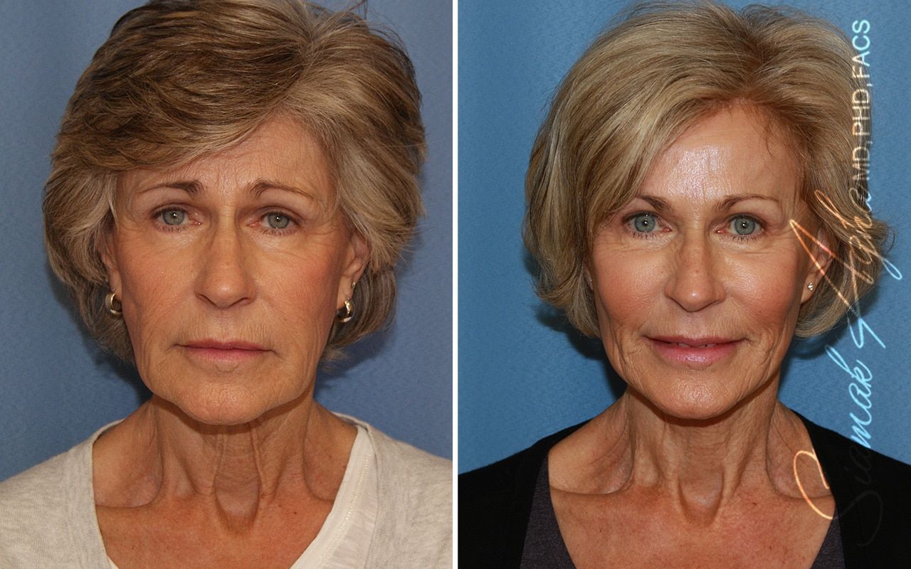 Facelift Before & After
