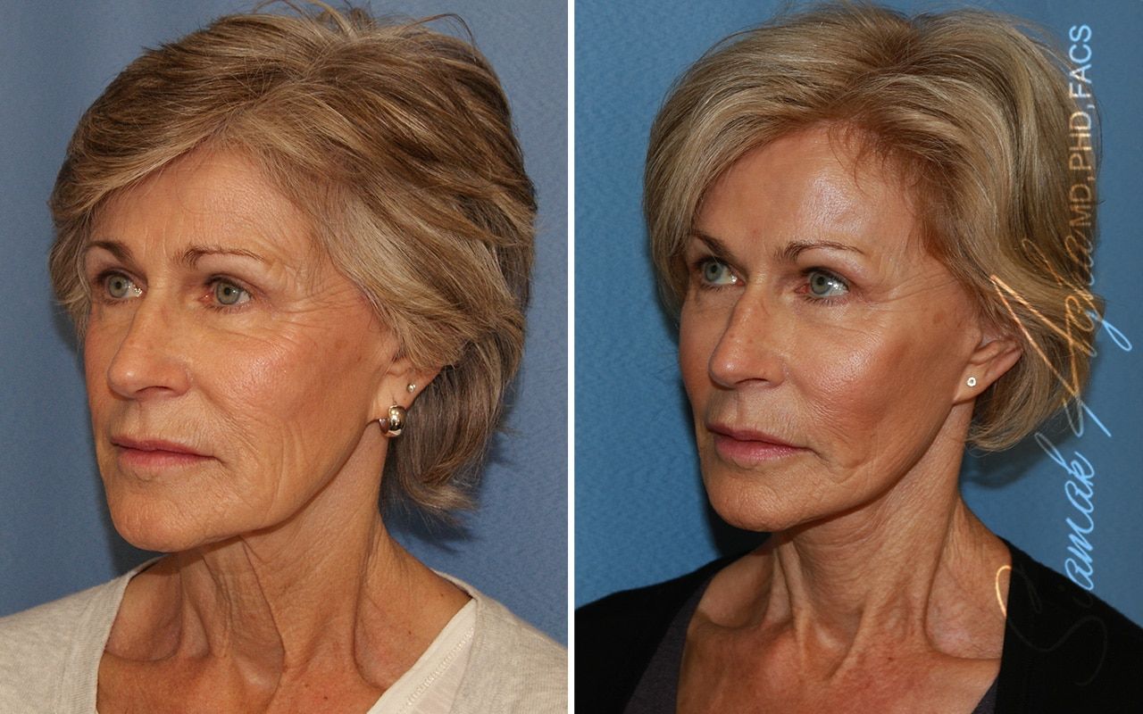 Facelift Before & After