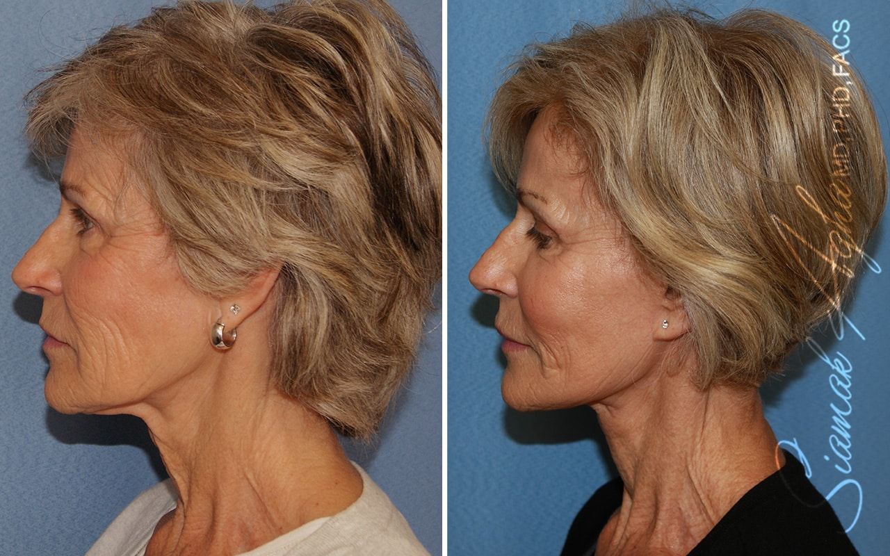 Facelift Before & After