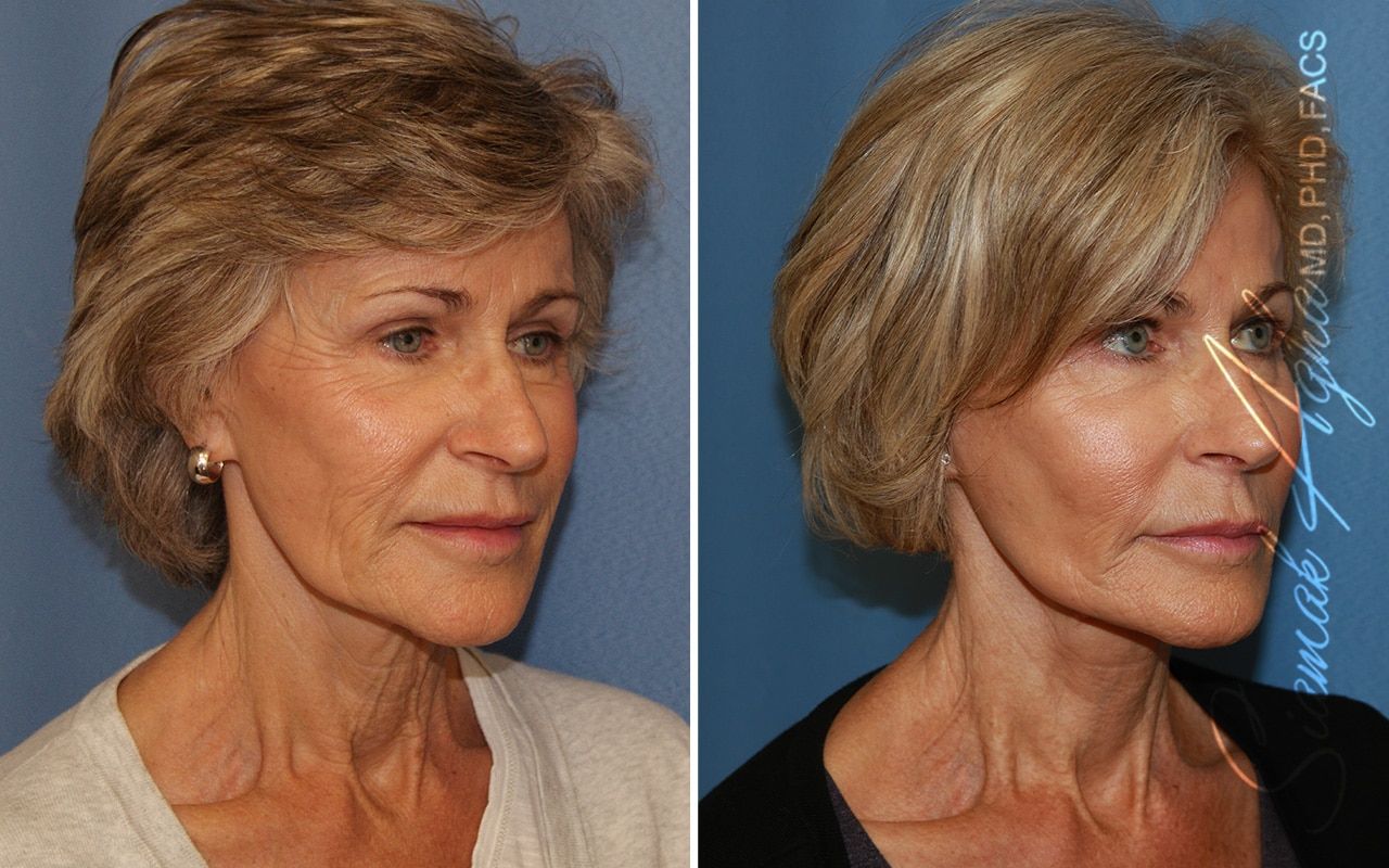 Facelift Before & After