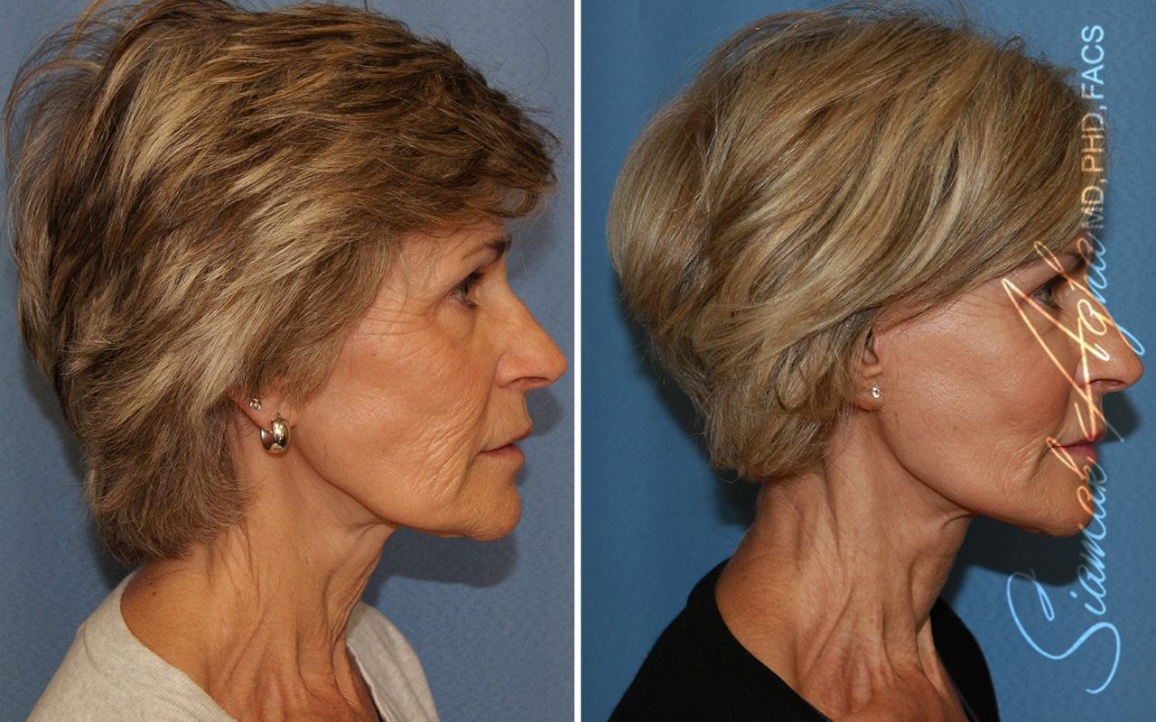Facelift Before & After