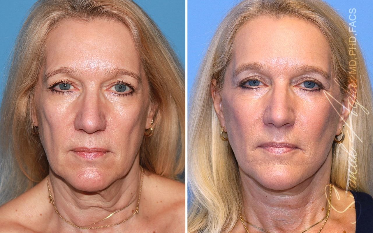Facelift Before & After
