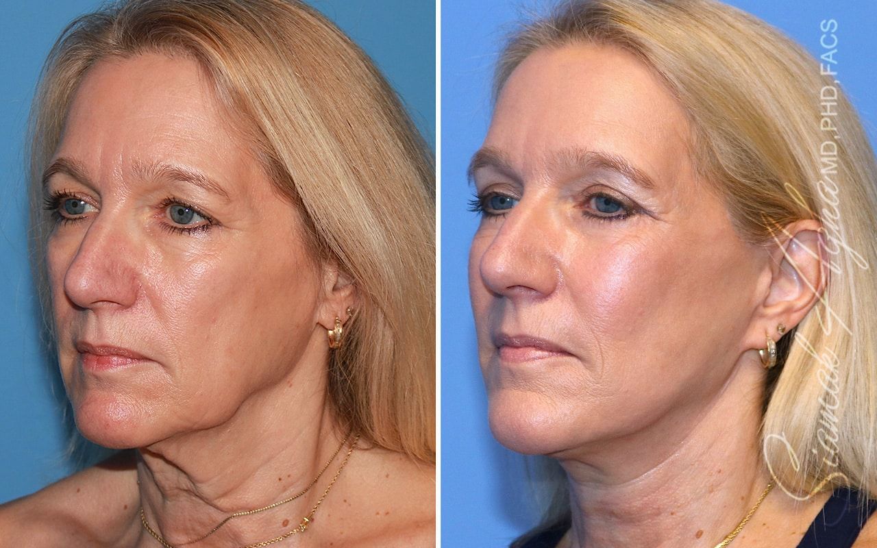 Facelift Before & After