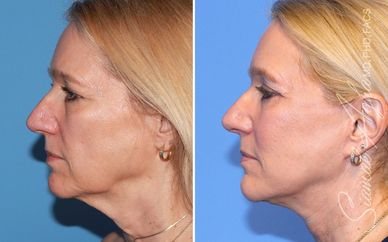 Facelift Before & After