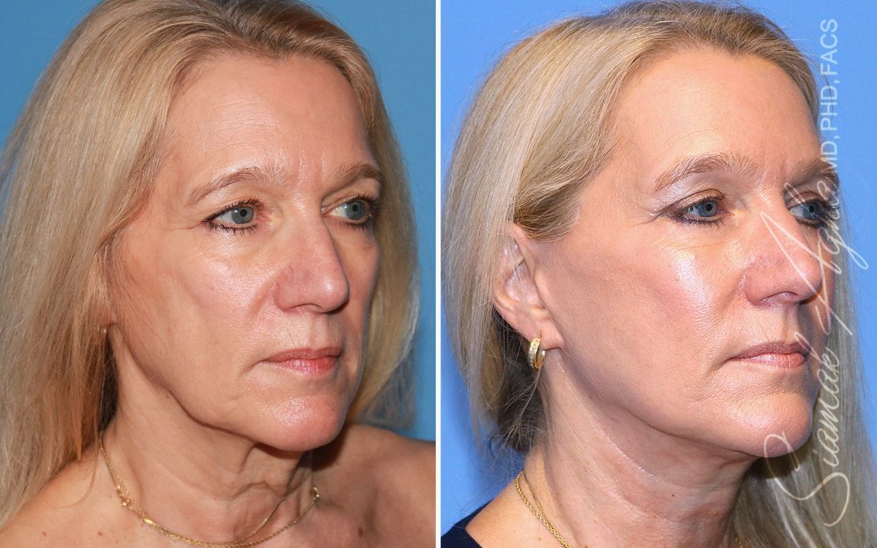 Facelift Before & After
