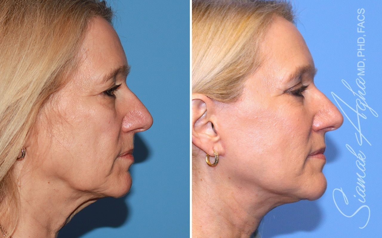 Facelift Before & After