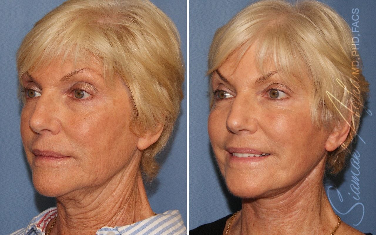 Facelift Before & After
