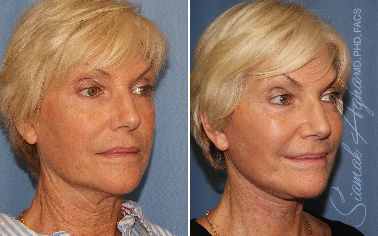 Facelift Before & After