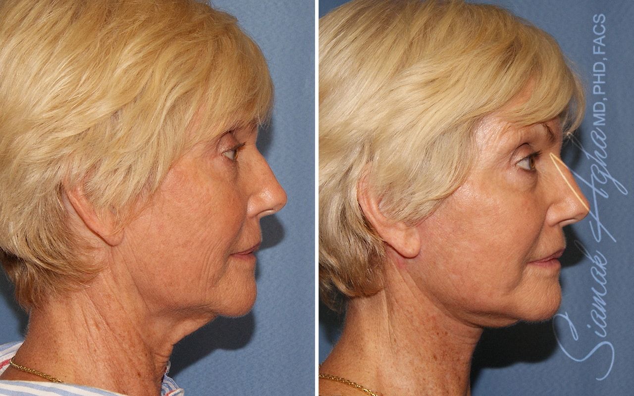 Facelift Before & After