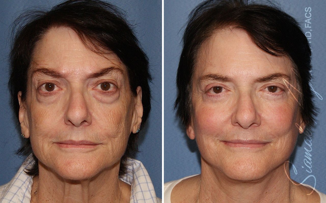 Facelift Before & After