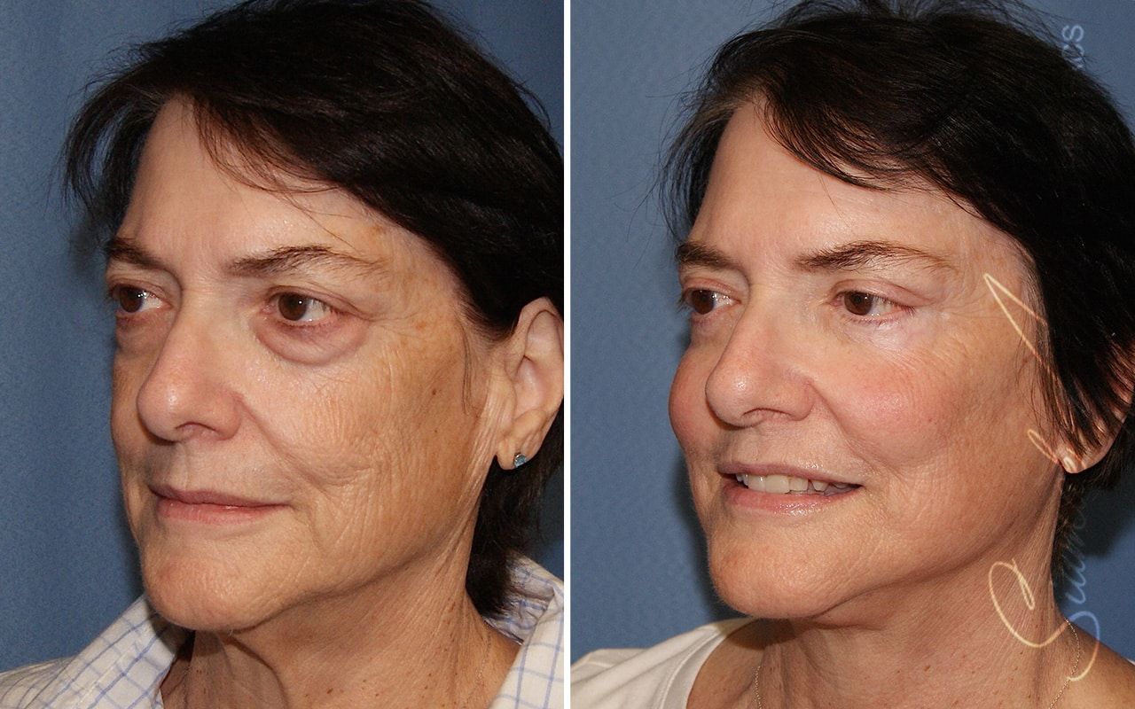 Facelift Before & After