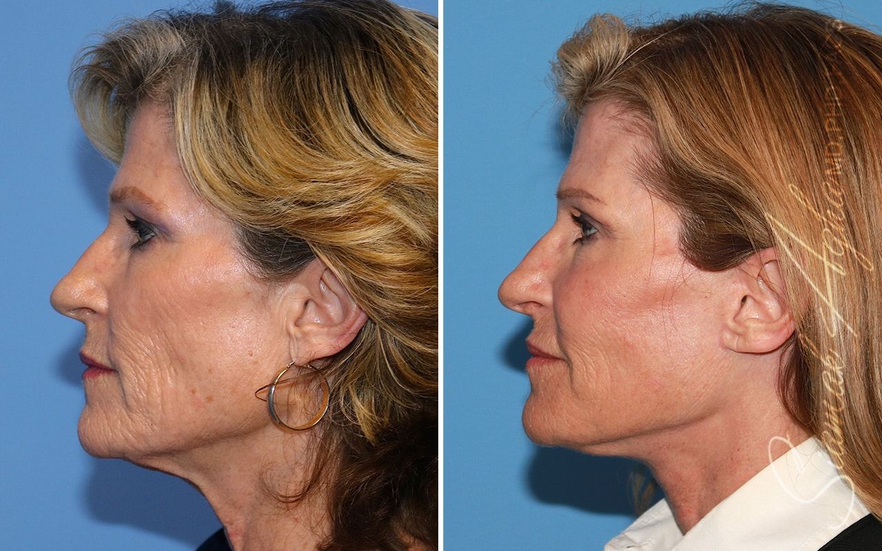 Facelift Before & After