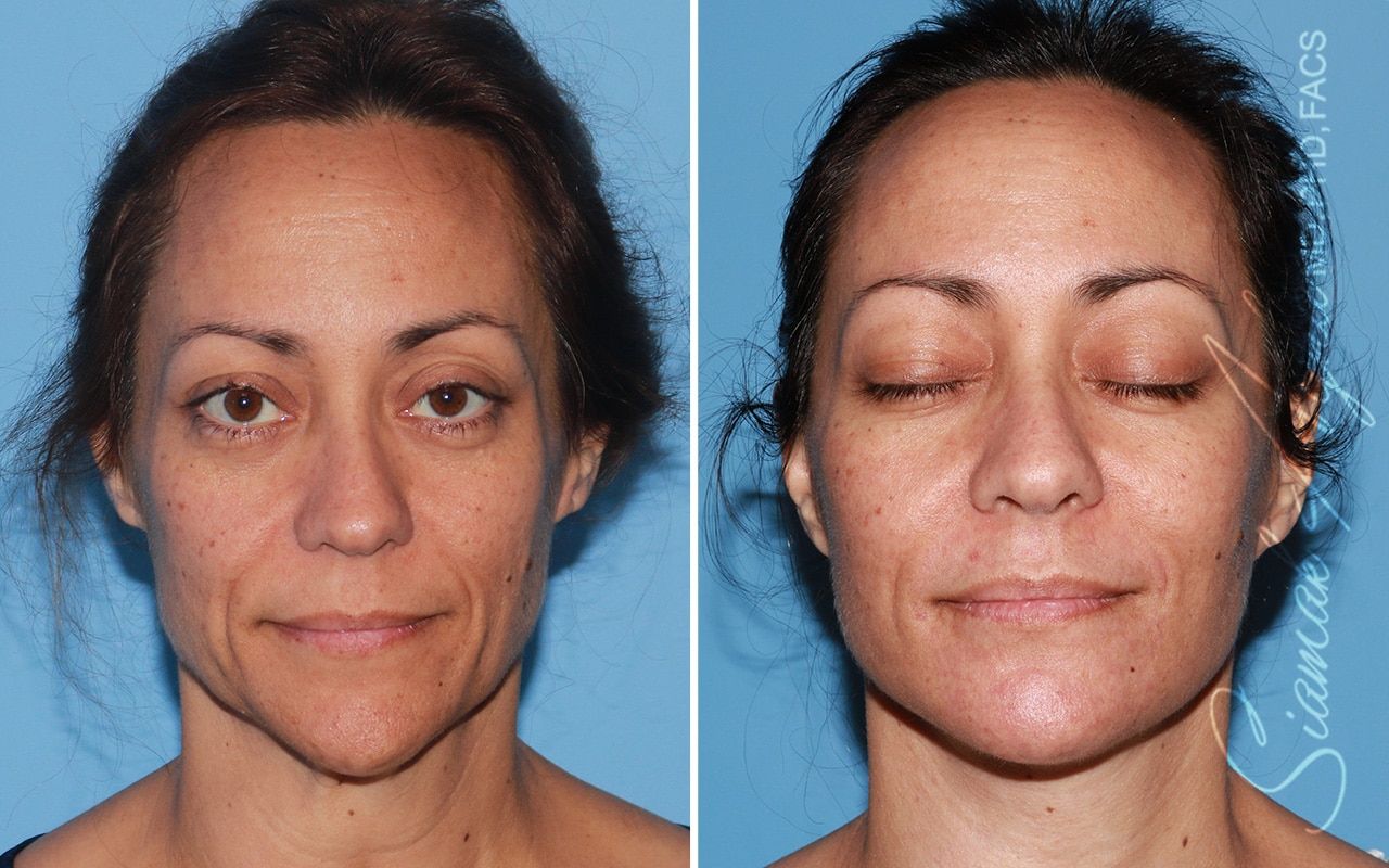 Facelift Before & After