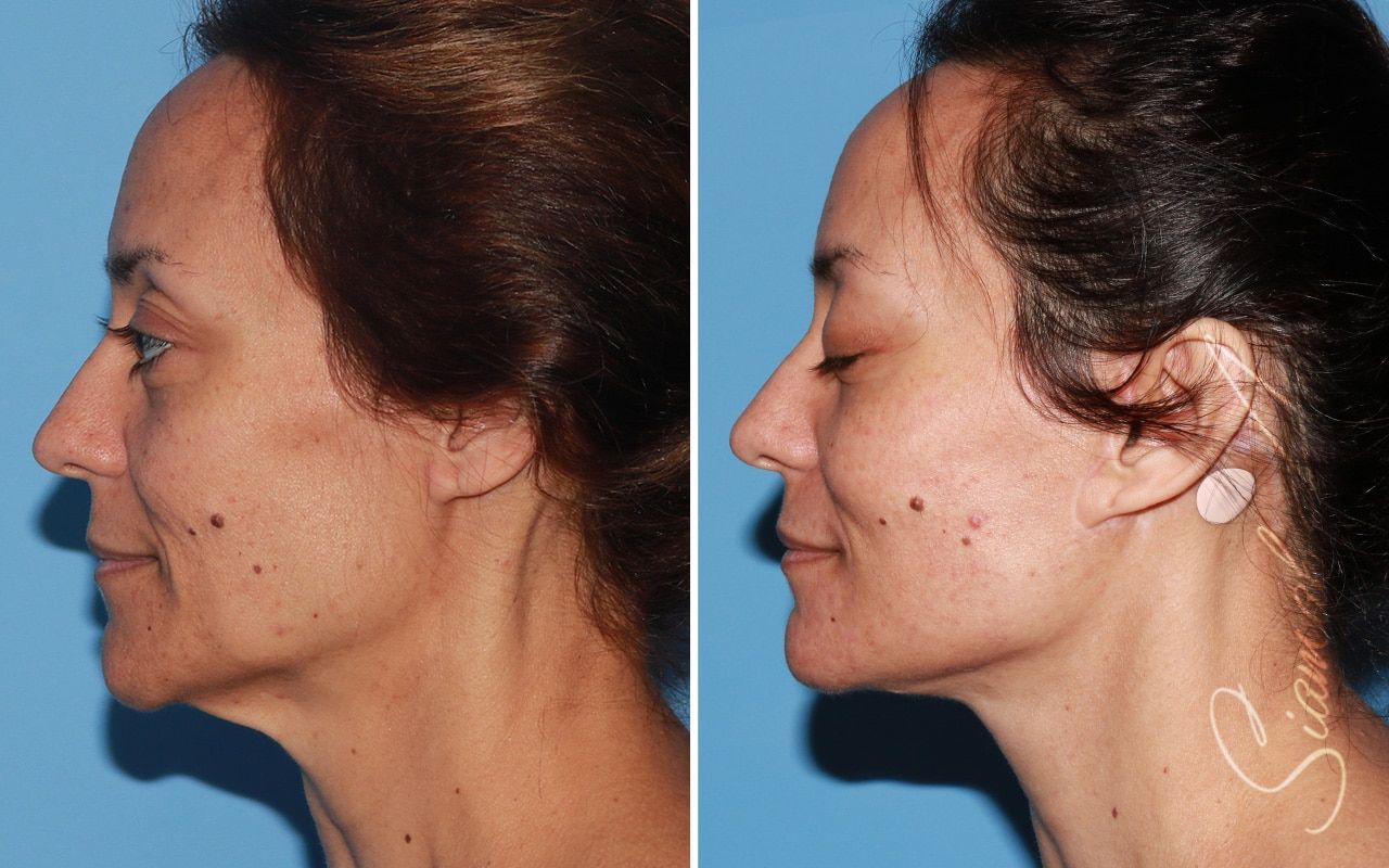 Facelift Before & After