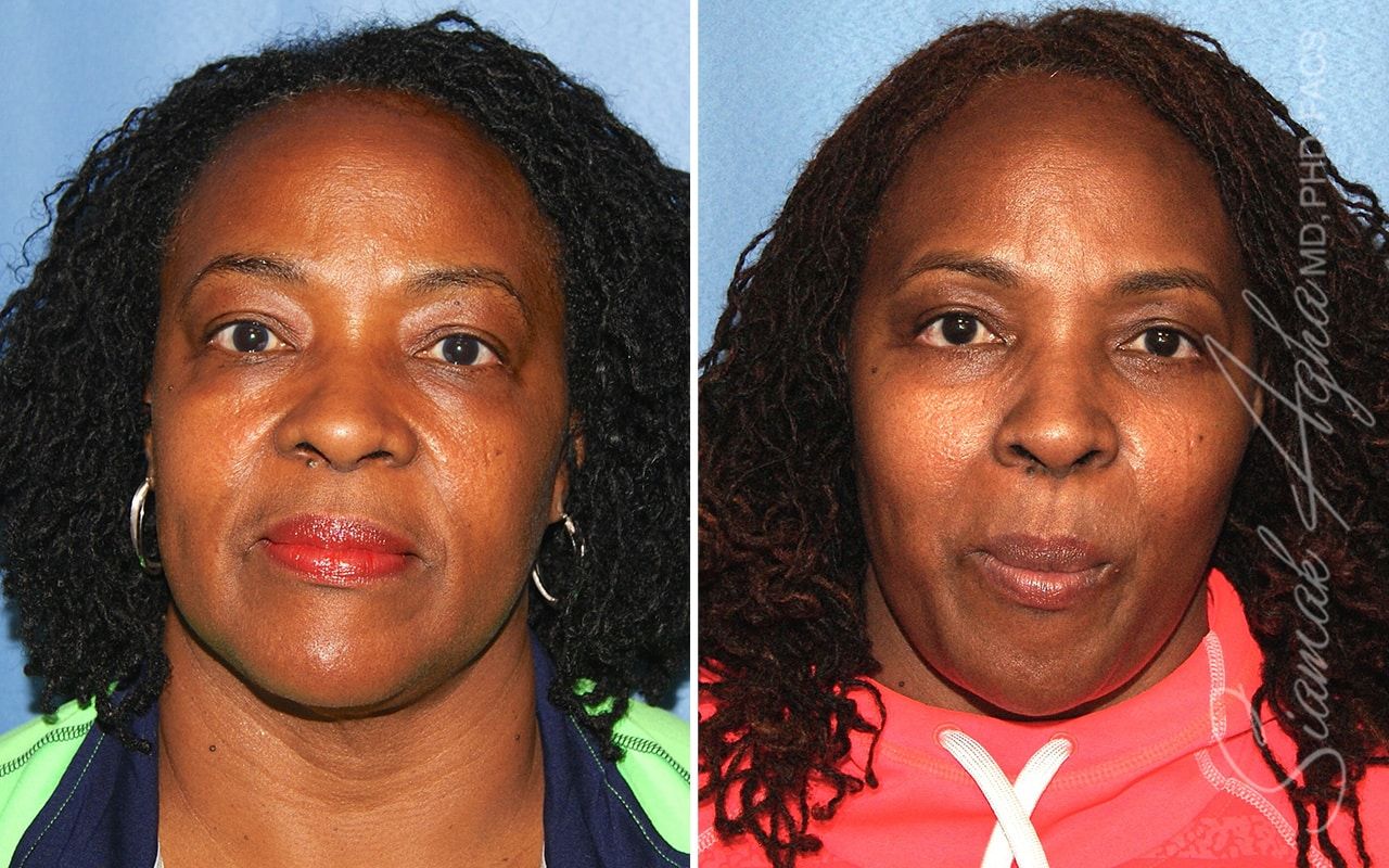 Facelift Before & After