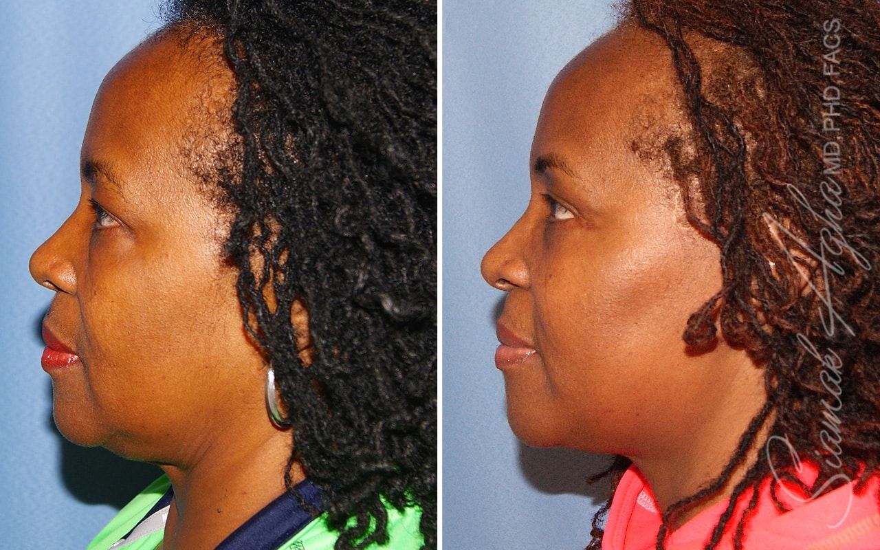 Facelift Before & After