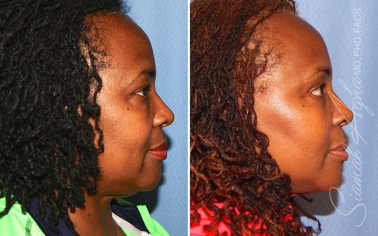 Facelift Before & After