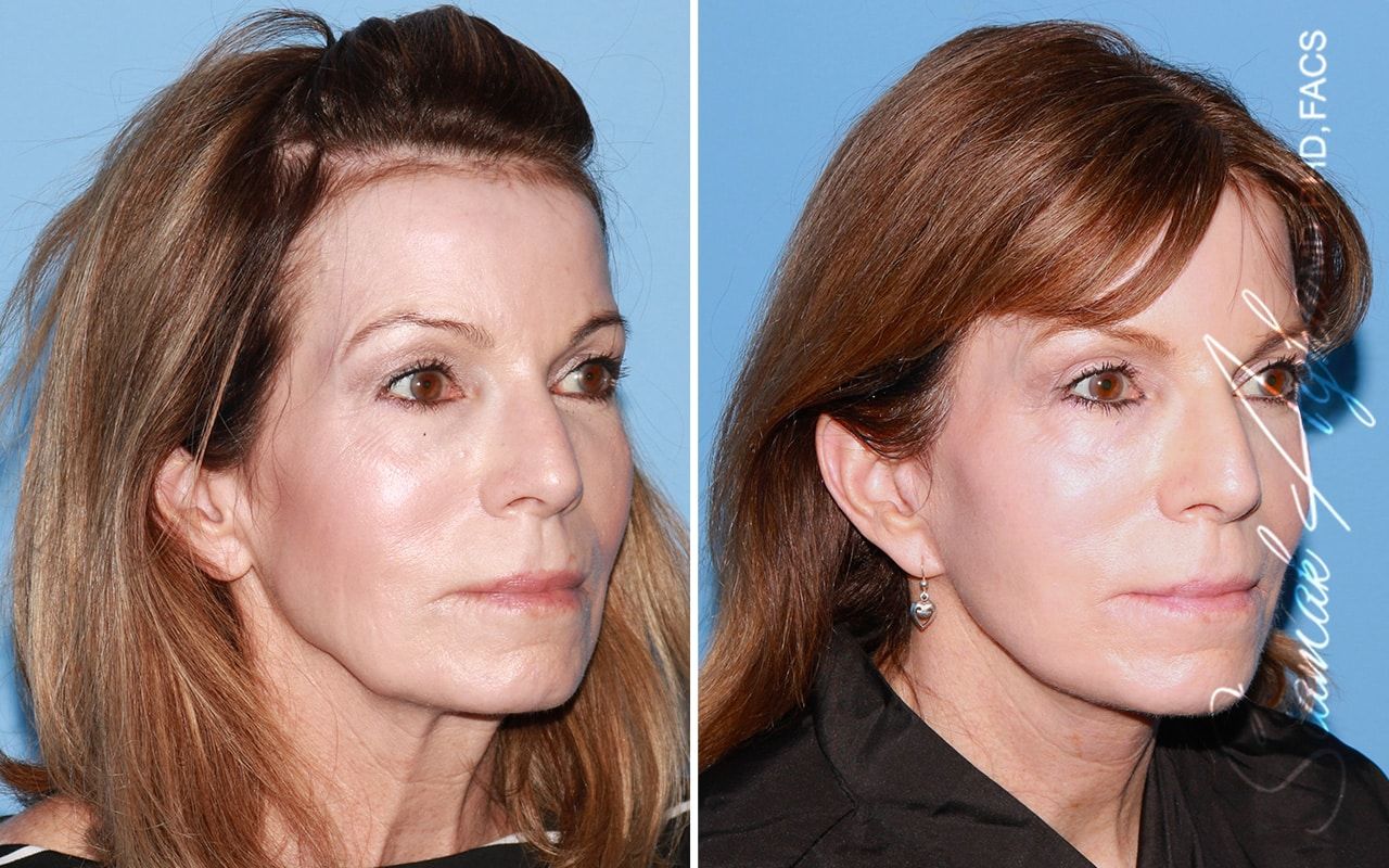 Facelift Before & After