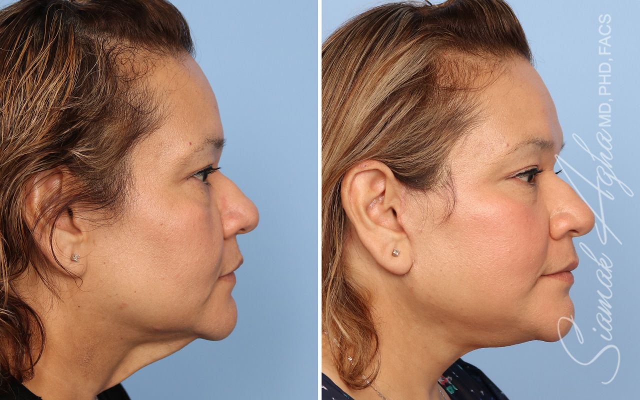 Facelift Before & After