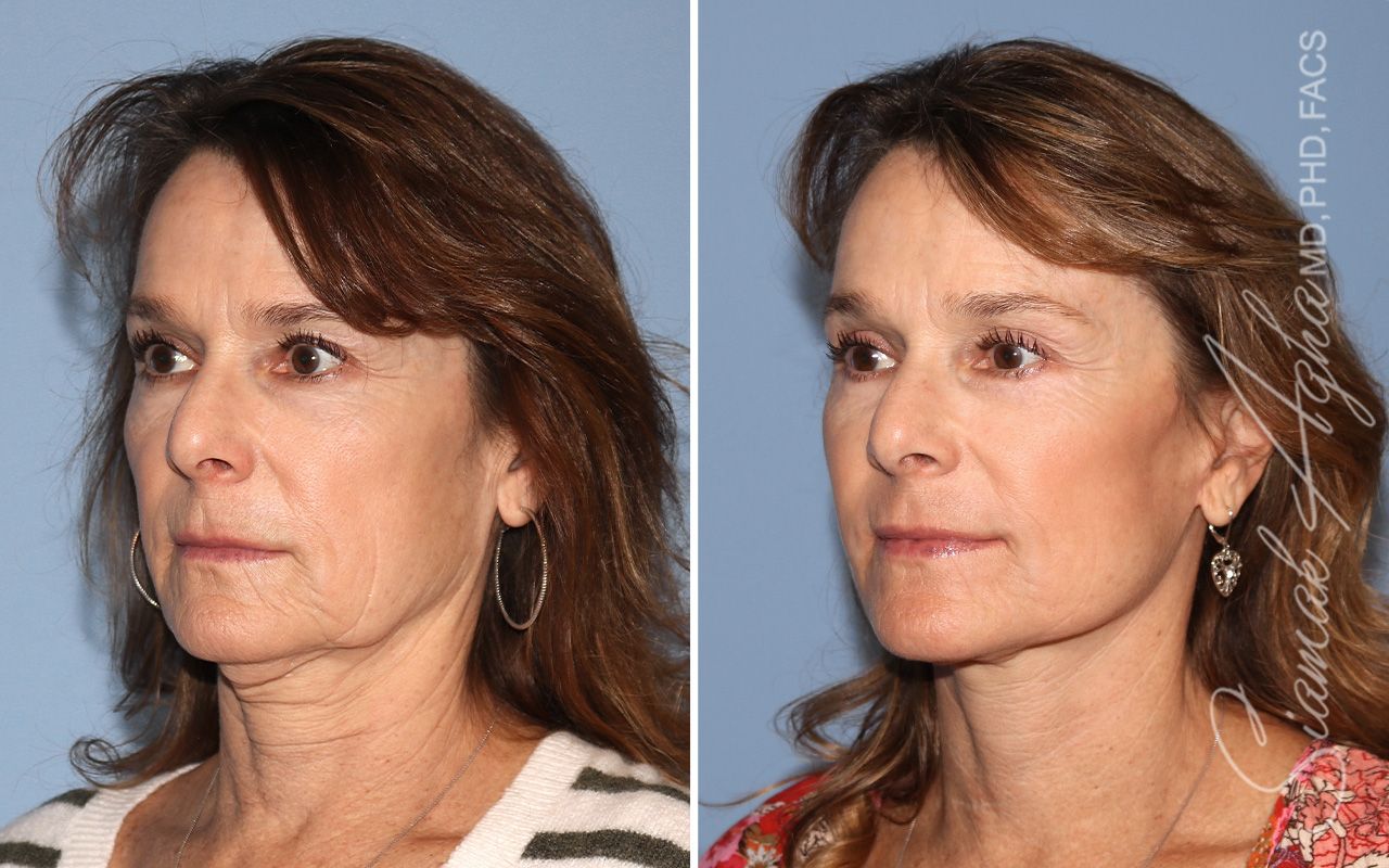 Facelift Before & After