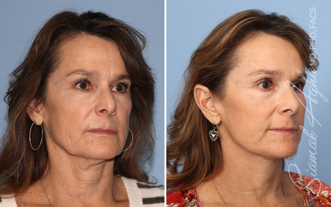 Facelift Before & After