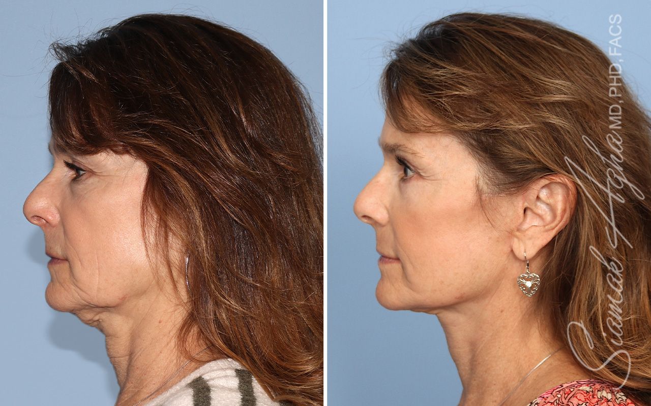 Facelift Before & After