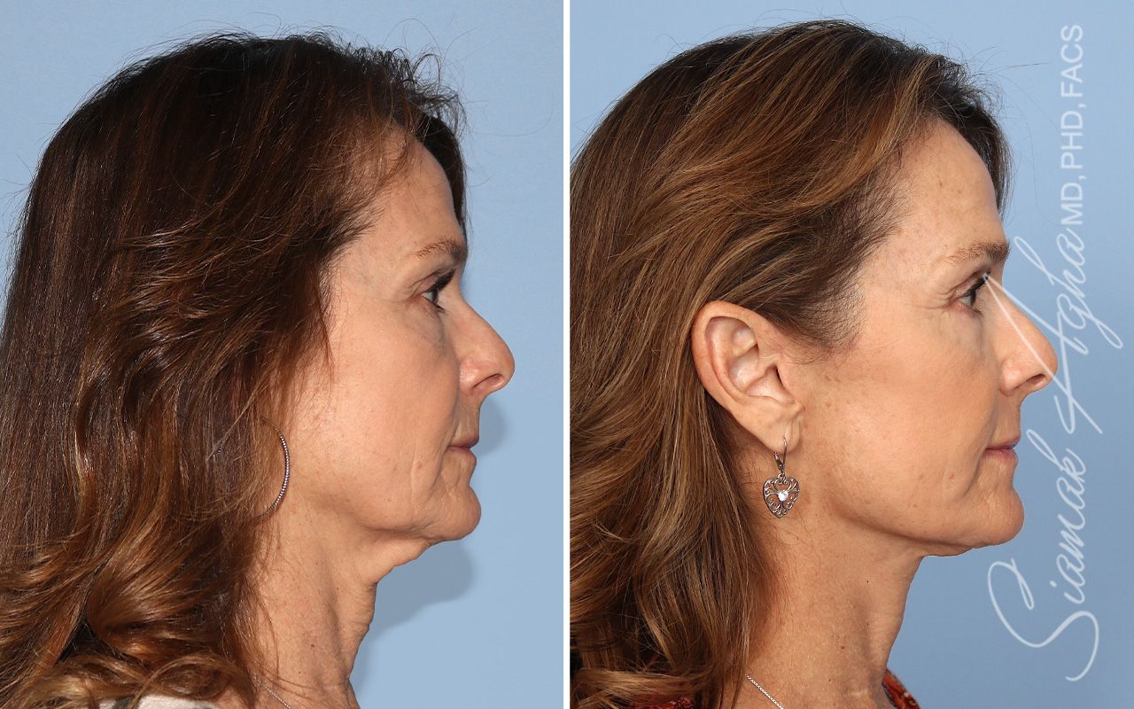 Facelift Before & After
