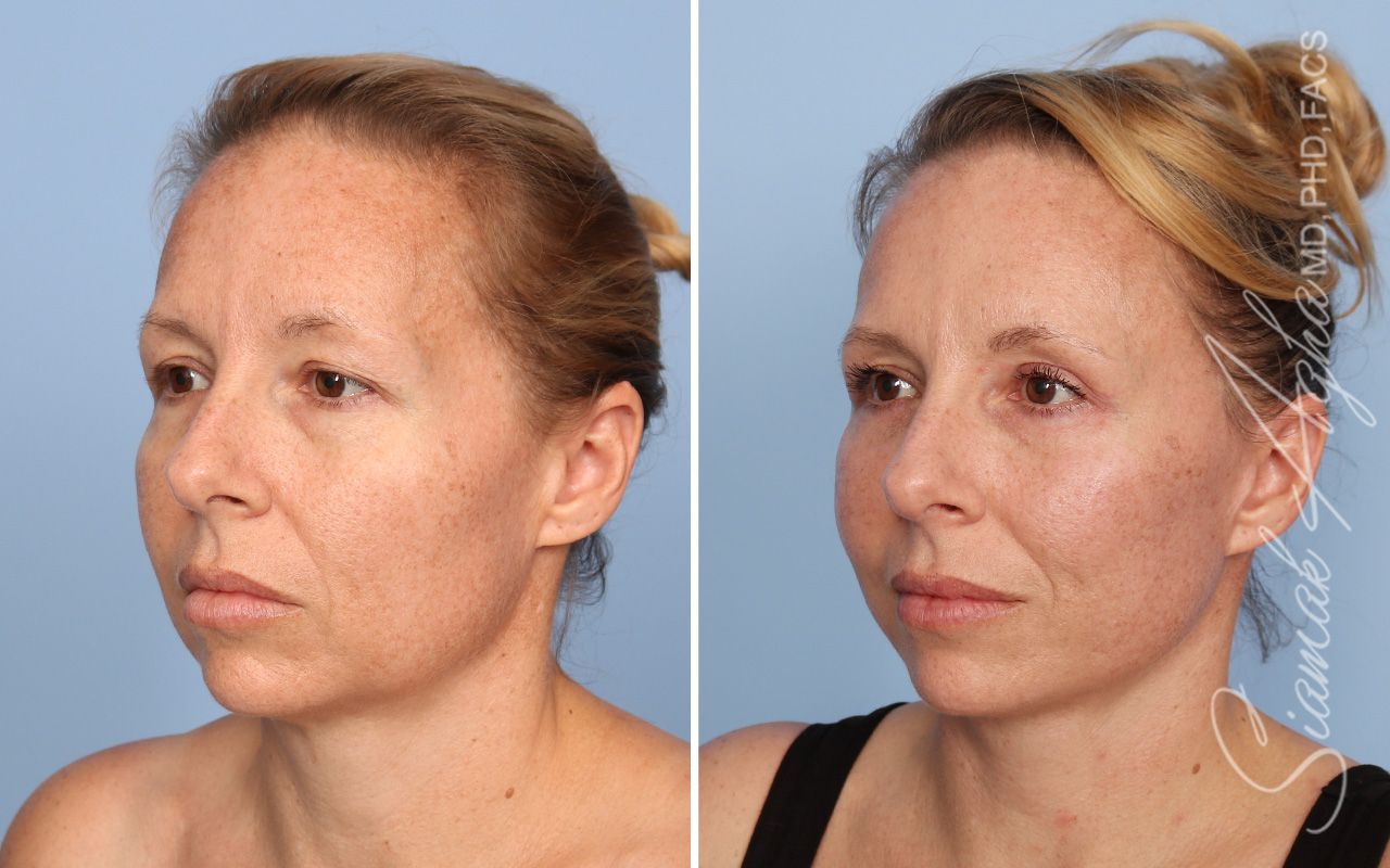 Facelift Before & After