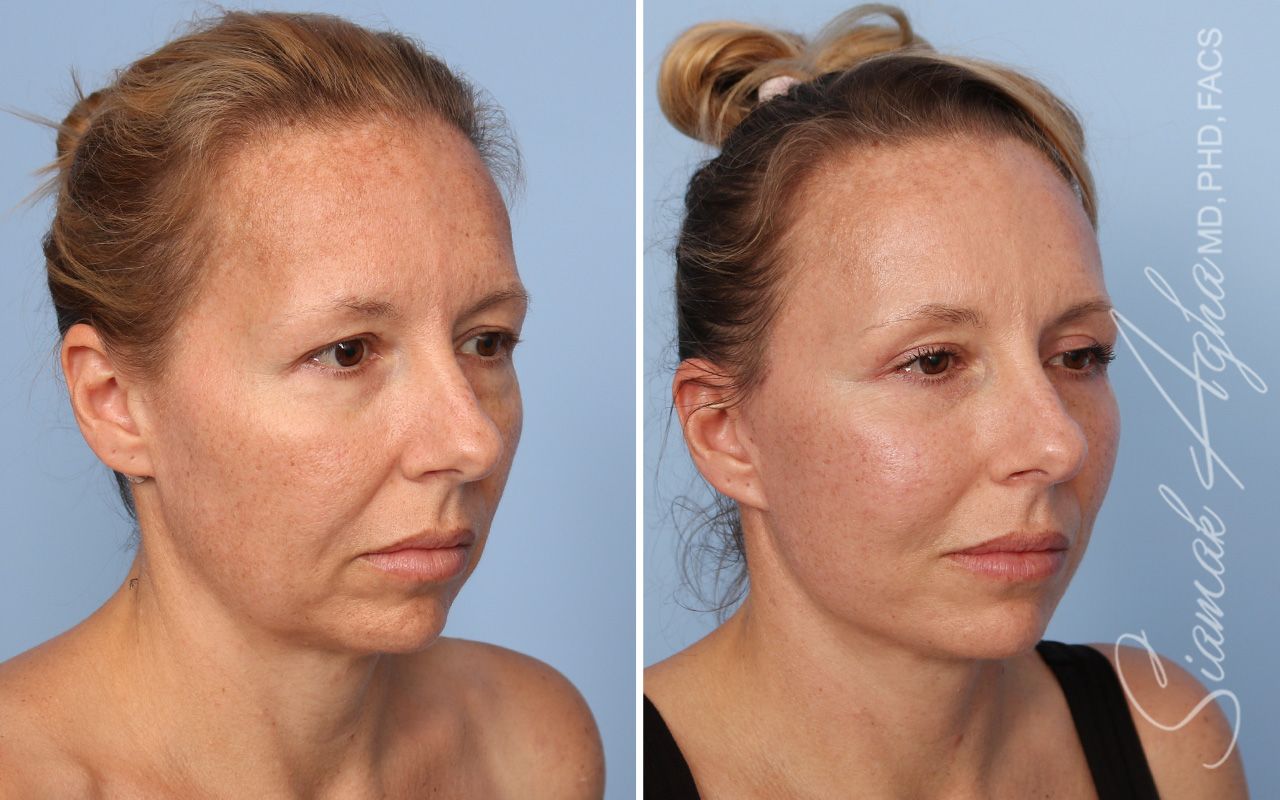 Facelift Before & After