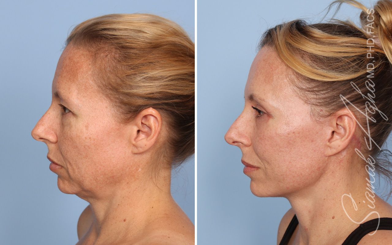 Facelift Before & After