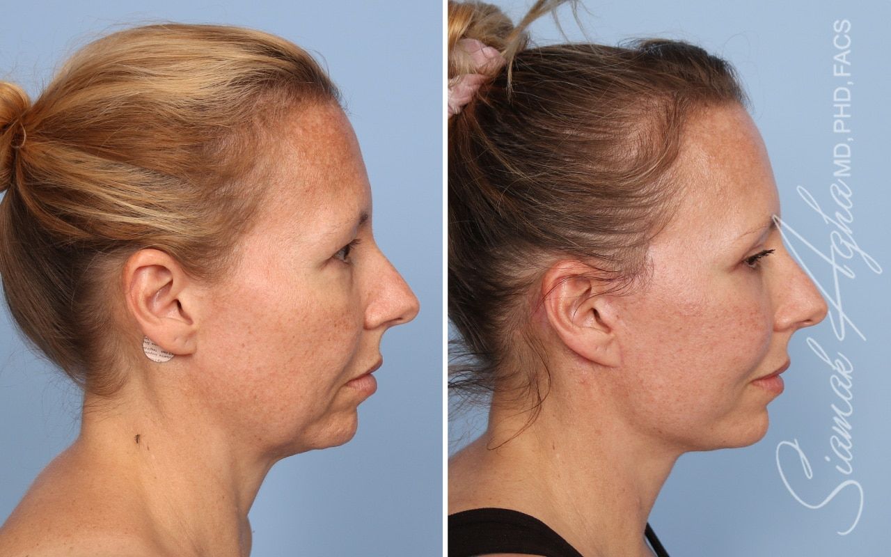 Facelift Before & After