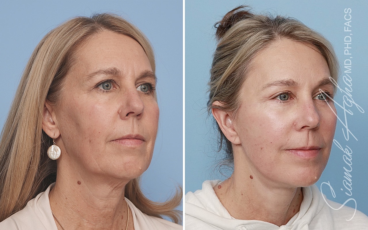 Facelift Before & After