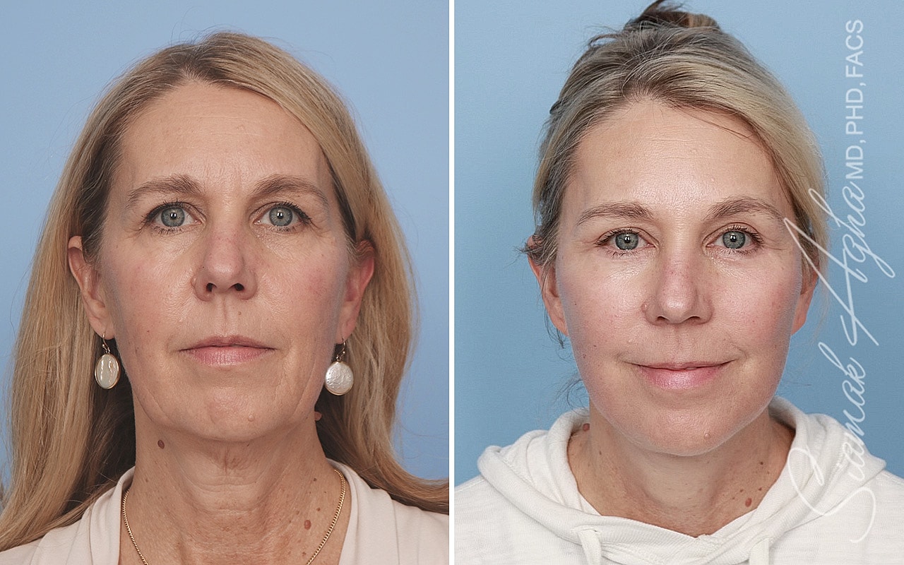 Facelift Before & After