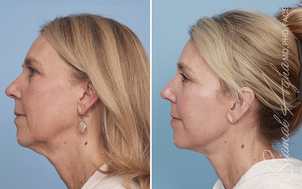 Facelift Before & After