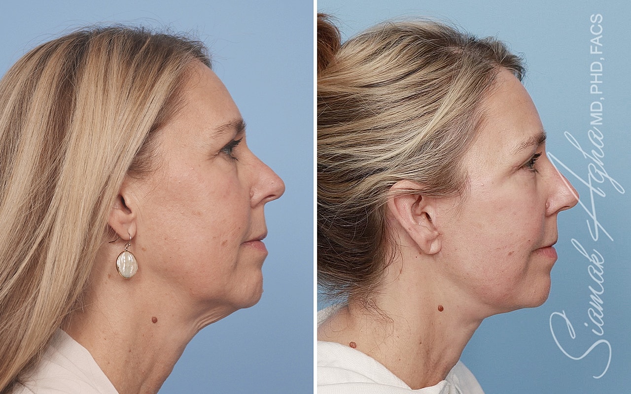 Facelift Before & After