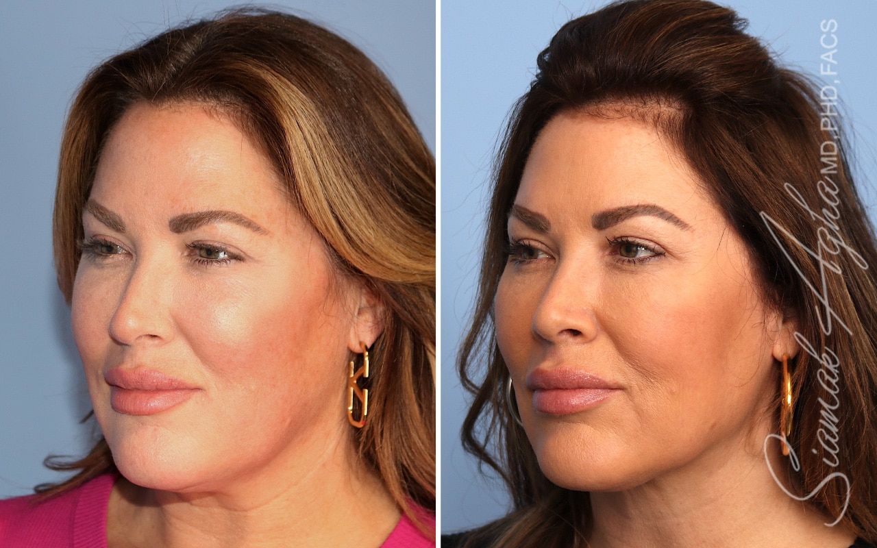 Facelift Before & After