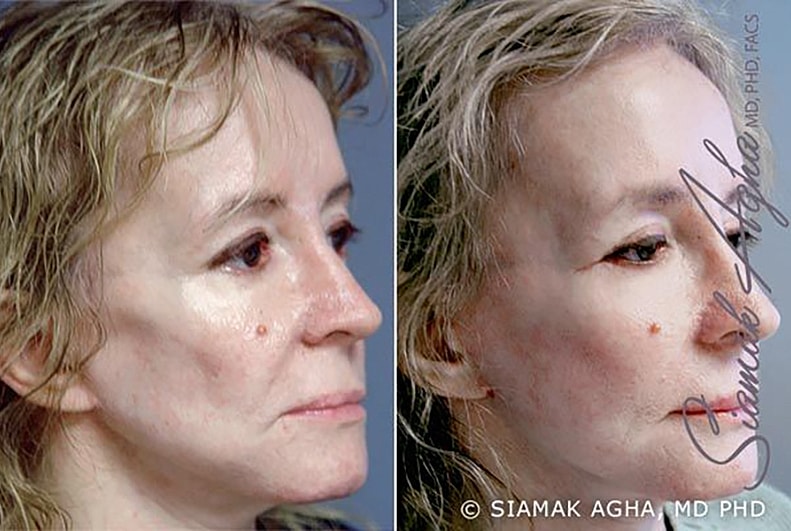 Facelift Before & After