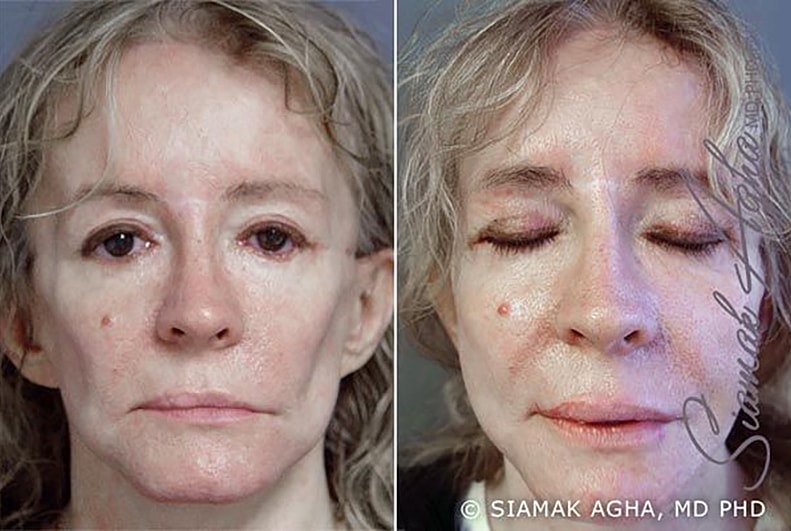 Facelift Before & After