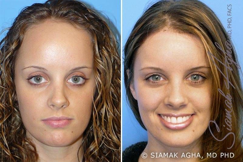 Forehead Reduction Before & After