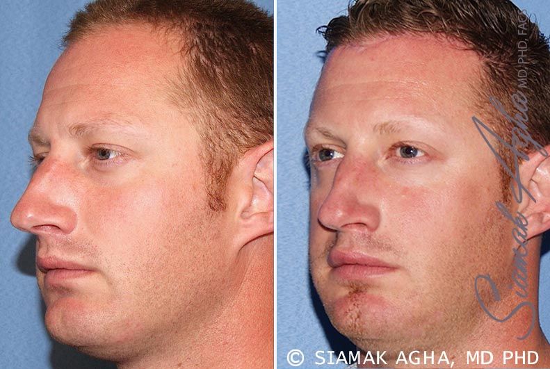 Forehead Reduction Before & After