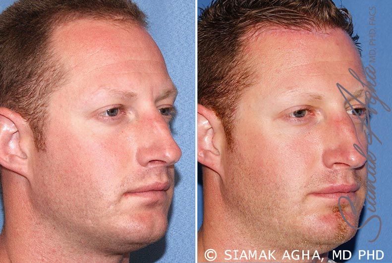 Forehead Reduction Before & After