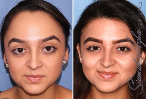 Forehead Reduction Before & After
