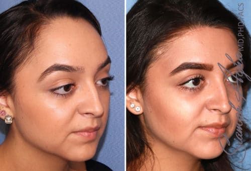Forehead Reduction Before & After