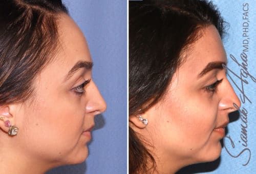 Forehead Reduction Before & After